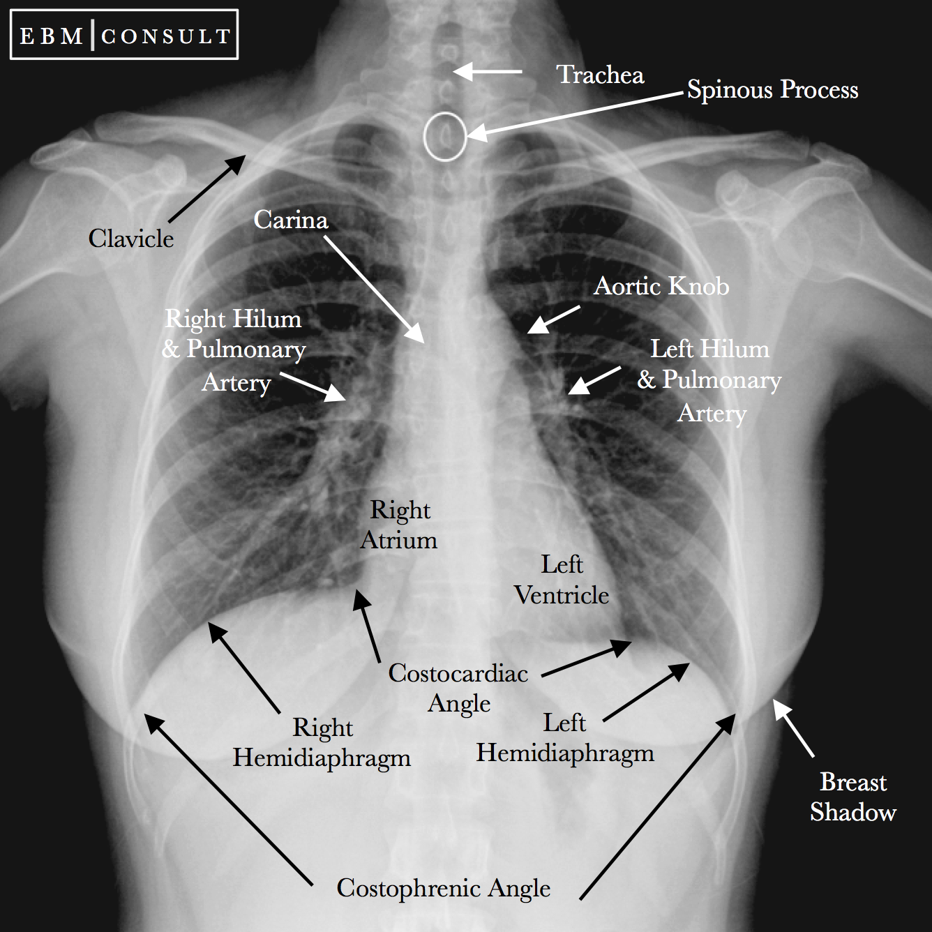 Lateral Chest X Ray Anatomy Anatomical Charts Posters