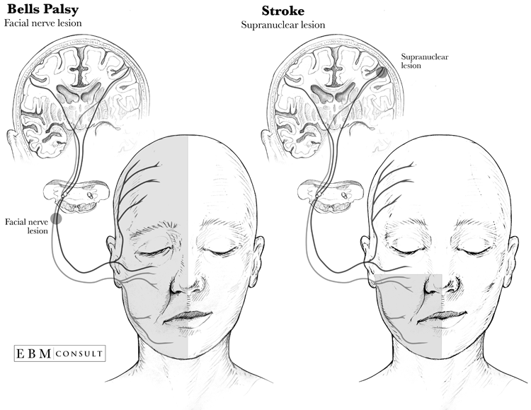 Bells Palsy vs Stroke Anatomy Image