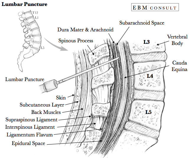 Lumbar Puncture Anatomy Needle Placement Image