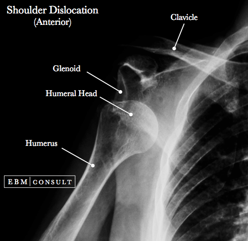 Shoulder Dislocation Image