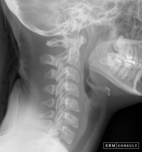 Lateral Cervical Spine Radiograph X Ray How To Read
