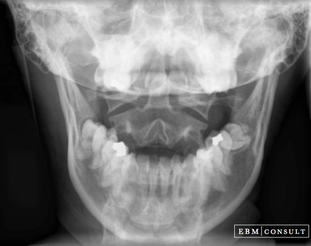 Open Mouth Odontoid Radiograph Xray View
