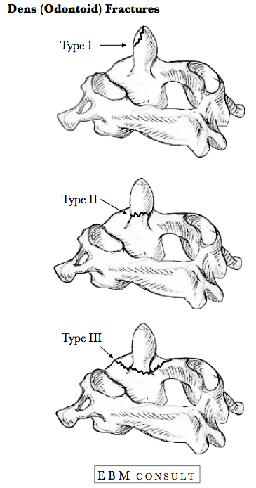 Dens (Odontoid) Fracture Image