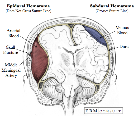 Subdural Epidural Hematoma Image