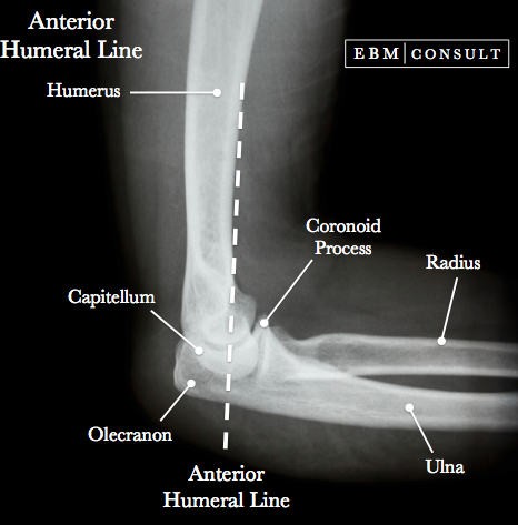 Anterior Humeral Line