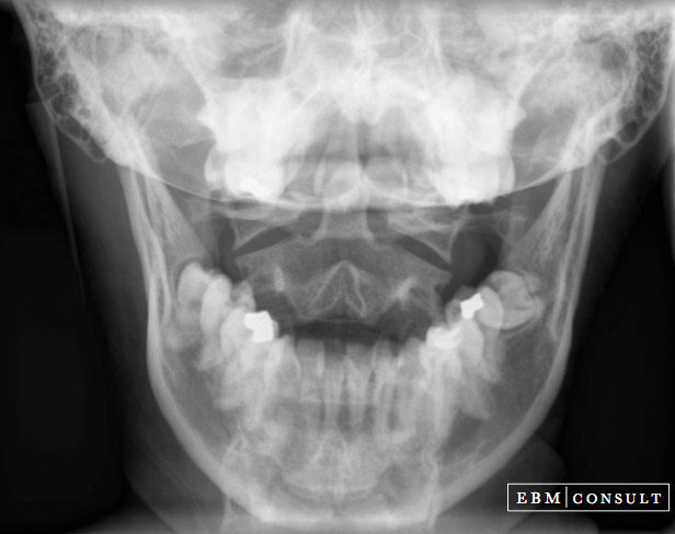 Basilar Invagination Lines Xray