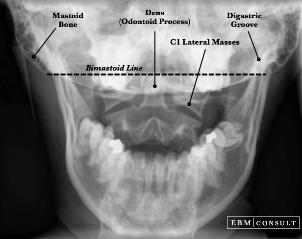 Bimastoid Line Image