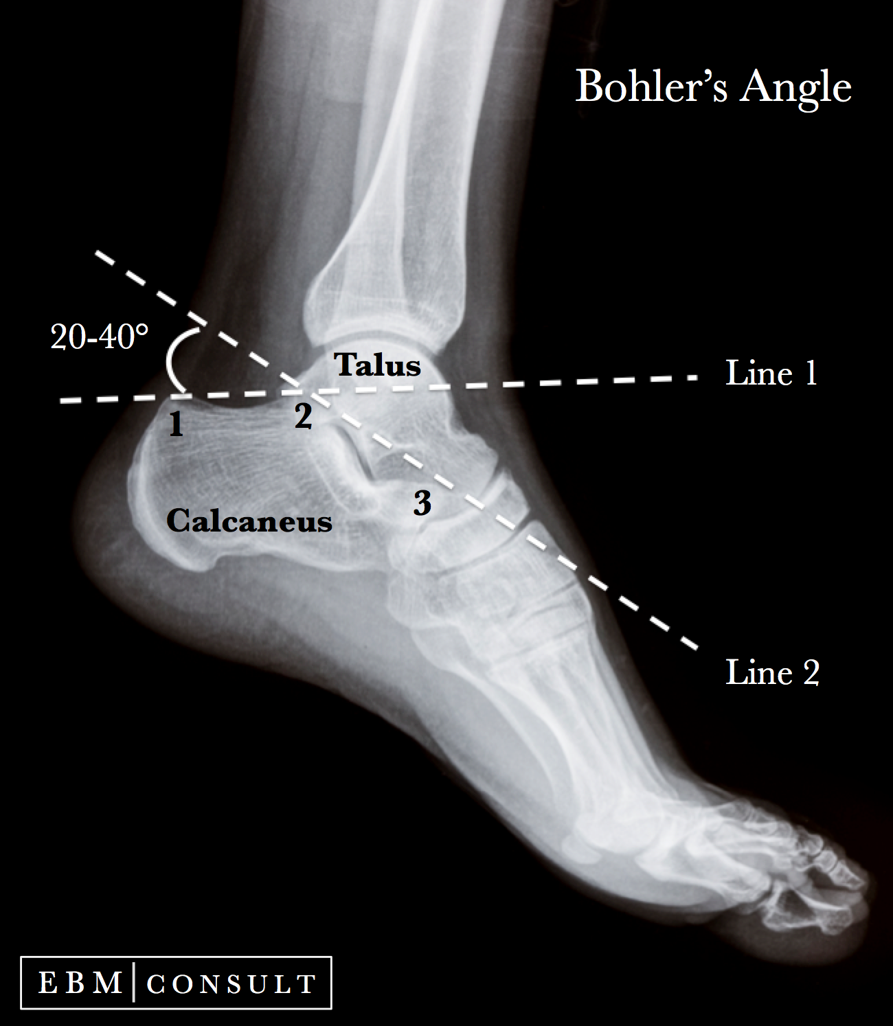Bohlers Angle Ankle Xray Image