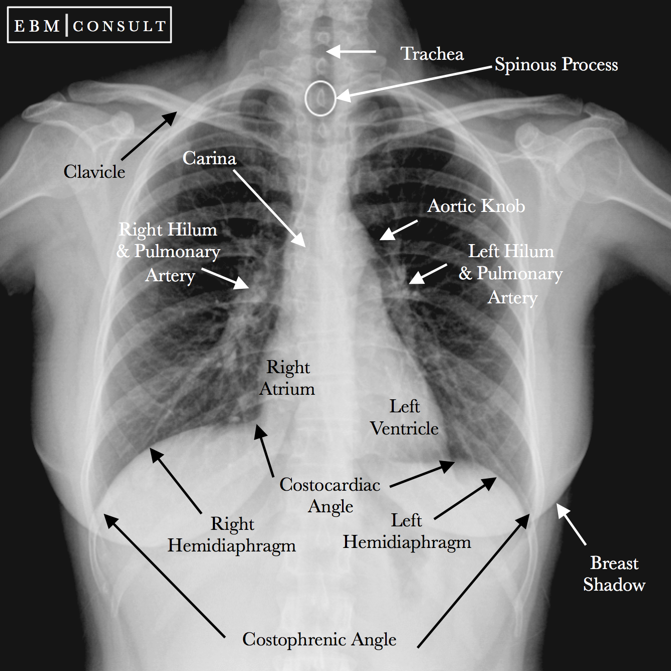Radiology Chest Xray Normal Radiology Chest Xray Normal