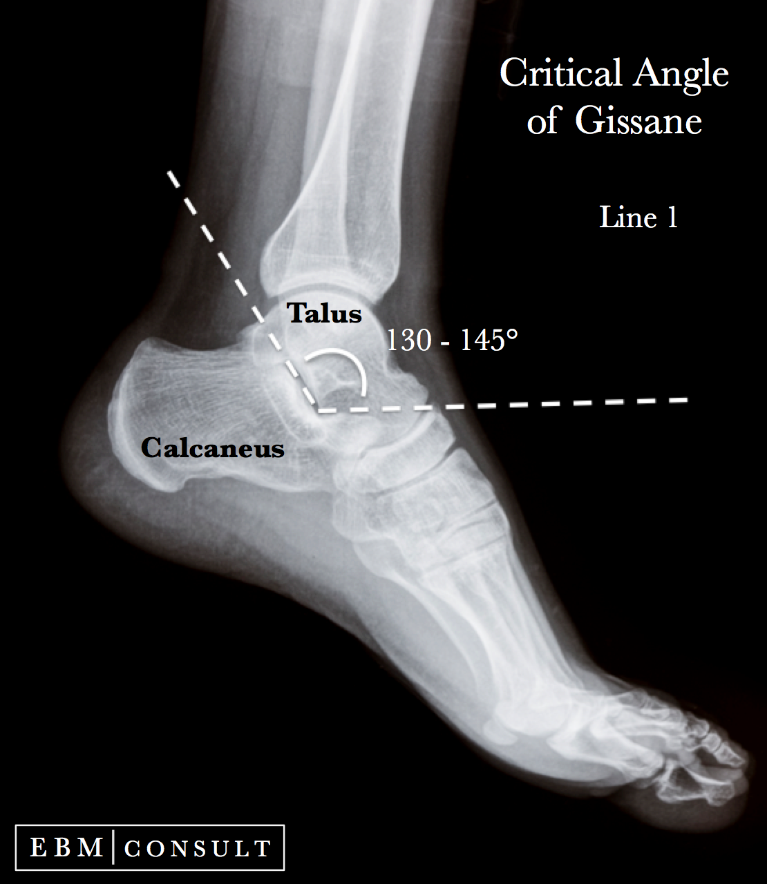 Gissane Angle Ankle Xray