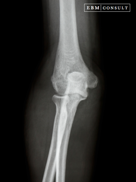 AP Elbow Xray Image