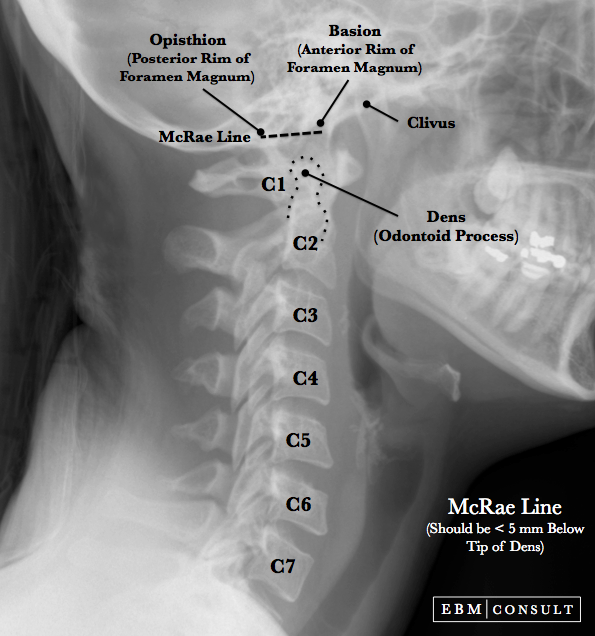 McRae Line Image