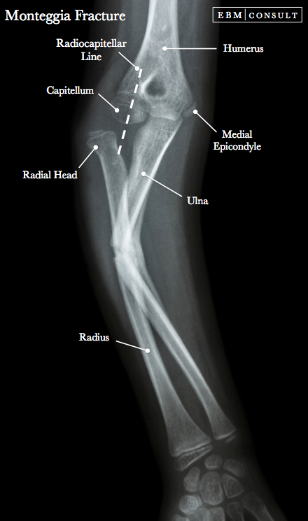 Monteggia Fracture Elbow Forearm