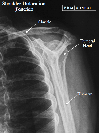 Posterior Shoulder Dislocation