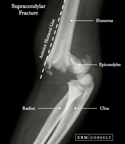 Supracondylar Fracture Image